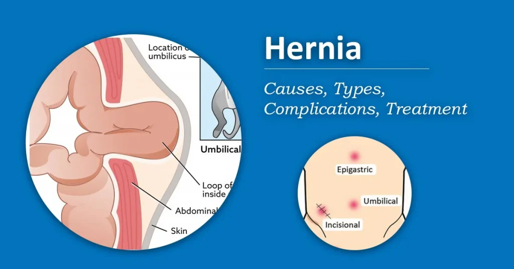 Top Non-Surgical Hernia Treatment Options