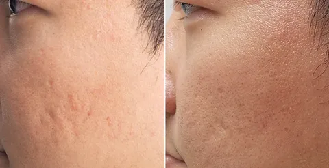 Acne Scar Removal Spring TX: Restore Smooth, Confident Skin